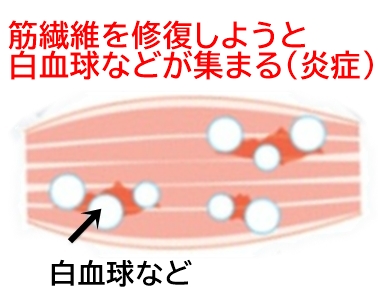 筋肉痛しくみ