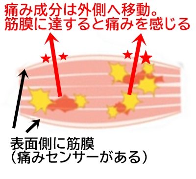 筋肉痛しくみ