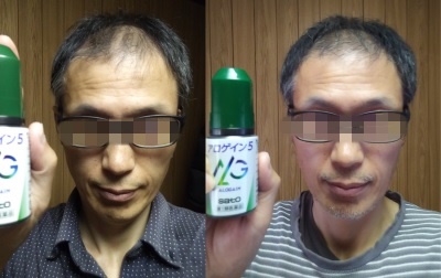 アロゲイン使用前 使用後 感想