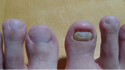 爪水虫で分厚く変色した爪