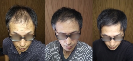 発毛剤使用 ビフォーアフター